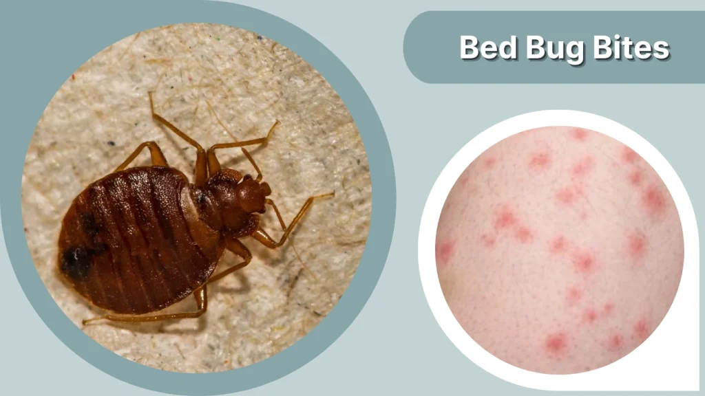 Bed Bug Bites
