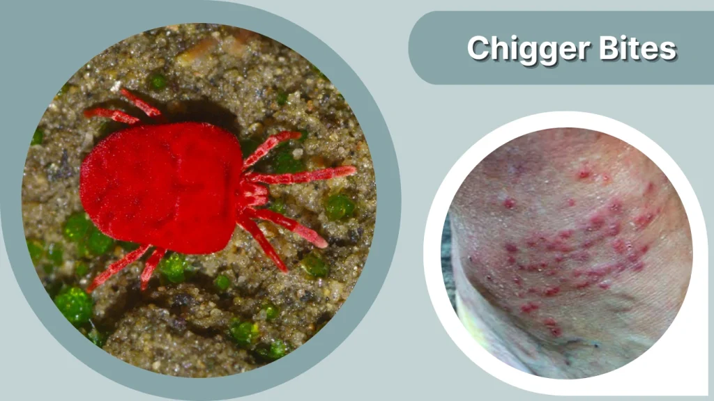 Chigger Bites