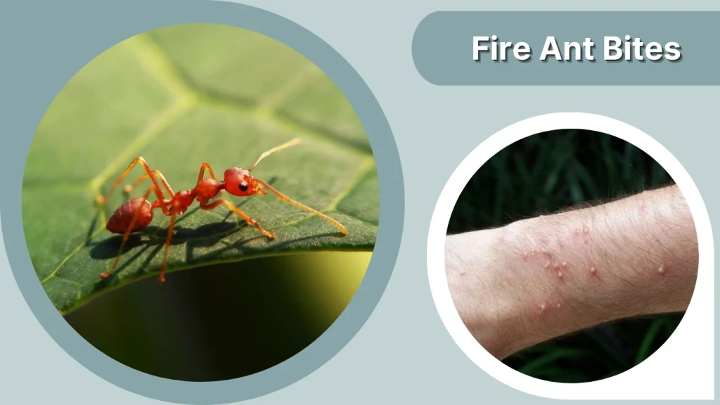 Fire Ant Bites