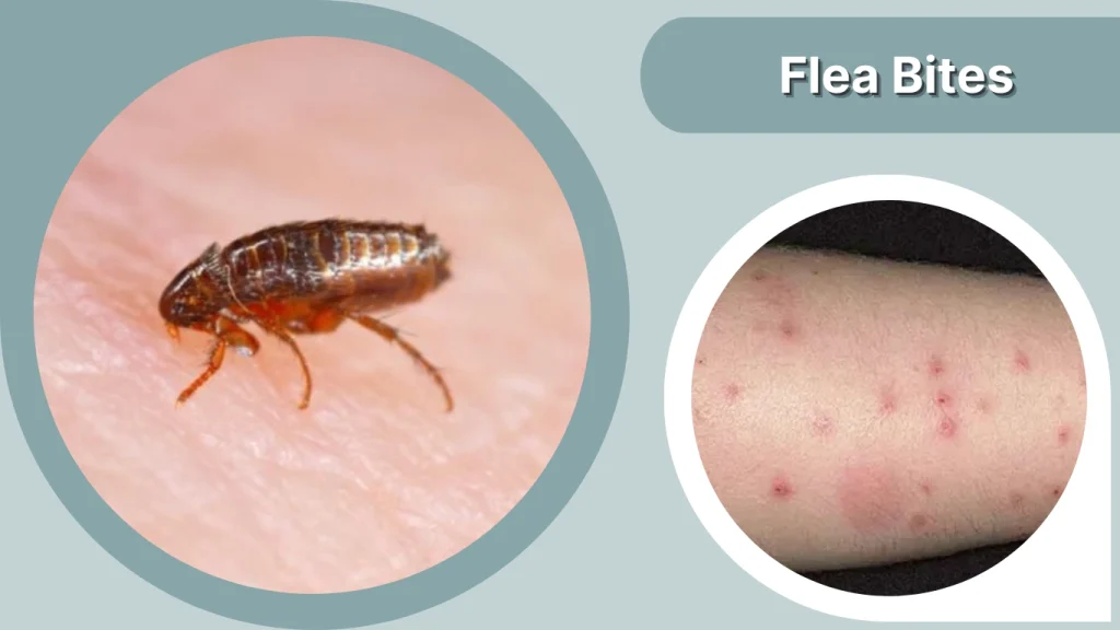 Flea Bites