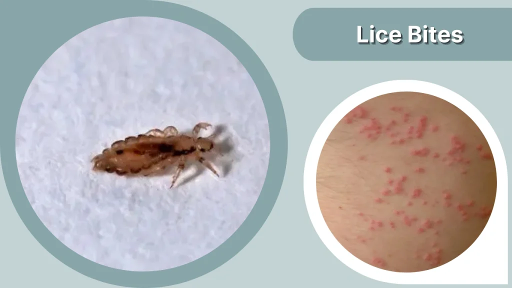 Lice Bites