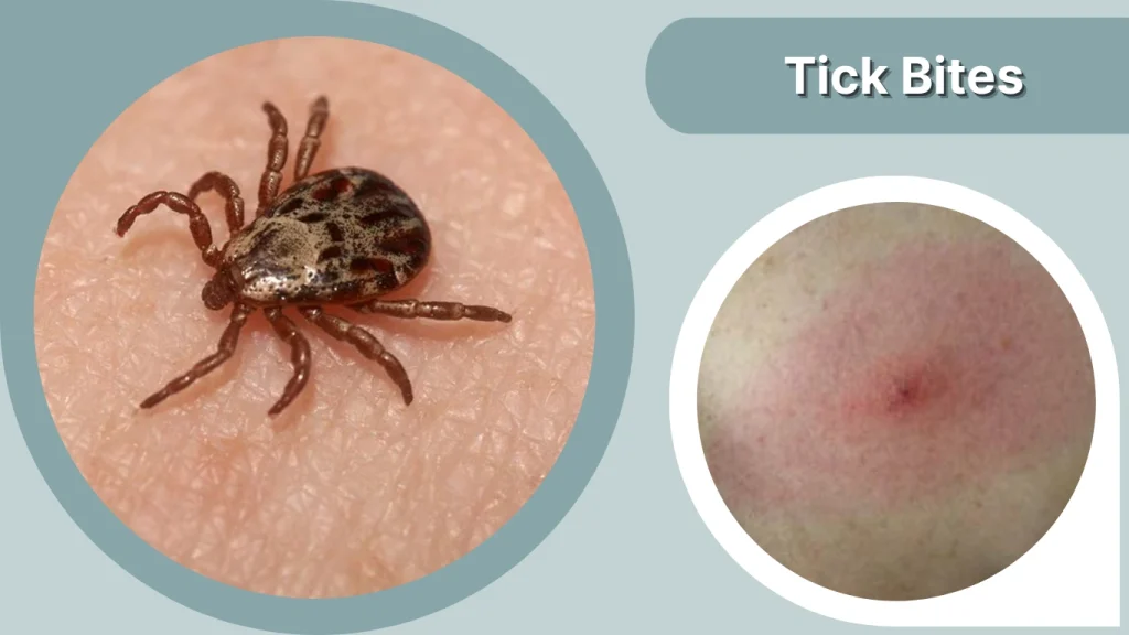 Tick Bites