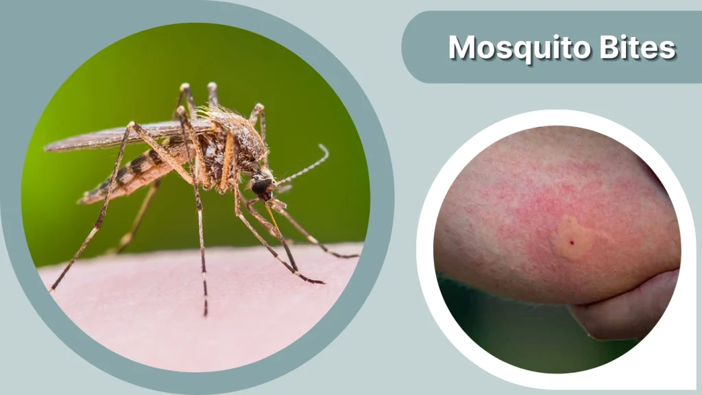 Mosquito Bites