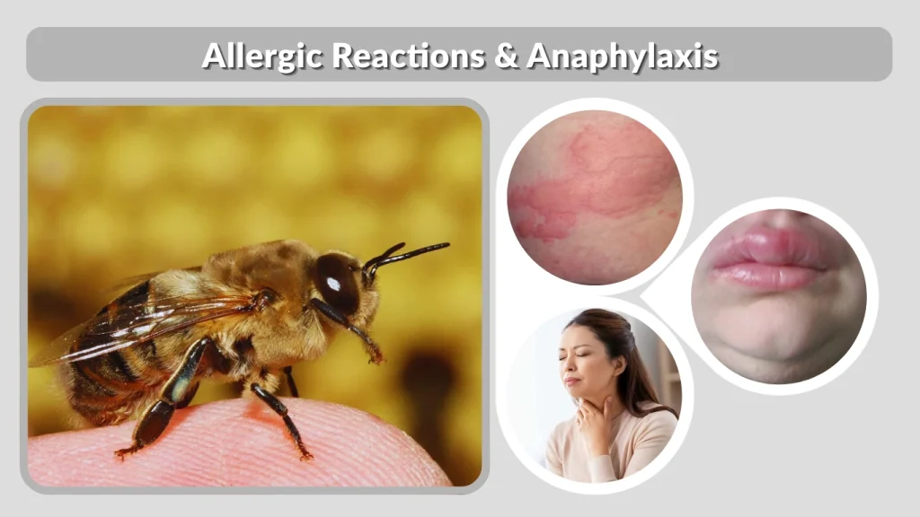 Allergic Reactions & Anaphylaxis