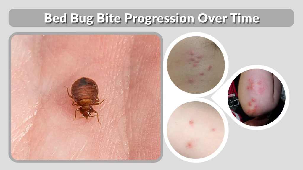 Bed Bug Bite Progression Over Time