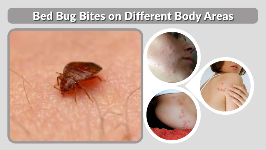 Bed Bug Bites on Different Body Areas