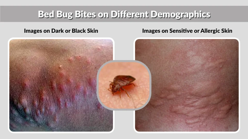 Bed Bug Bites on Different Demographics