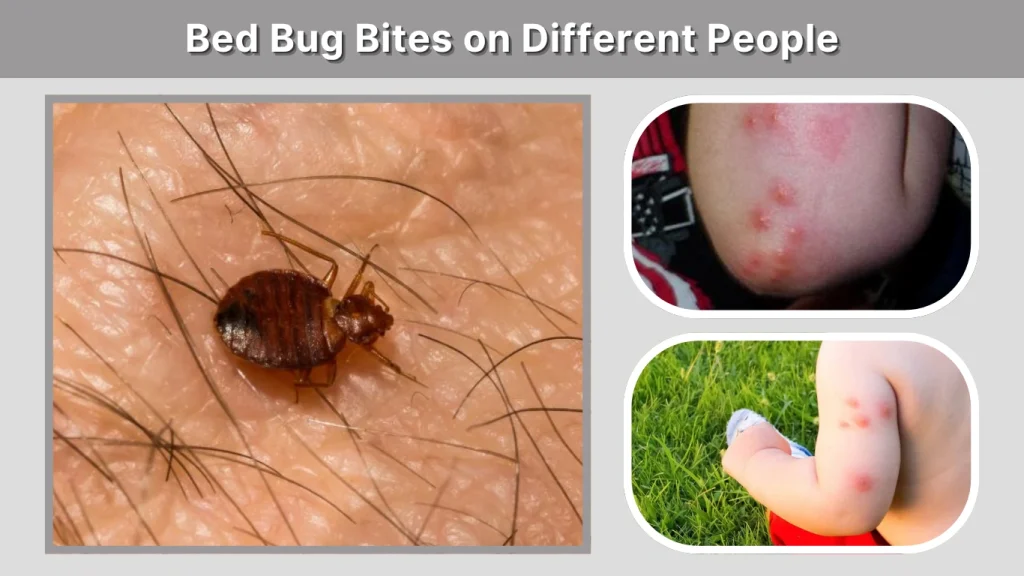 Bed Bug Bites on Different People