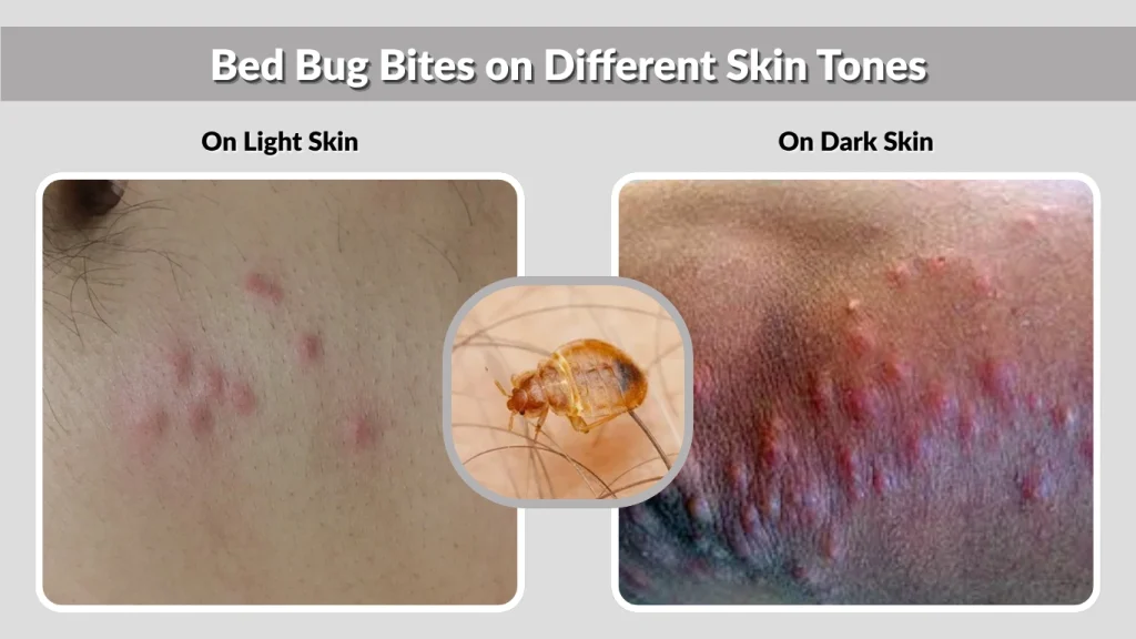 Bed Bug Bites on Different Skin Tones