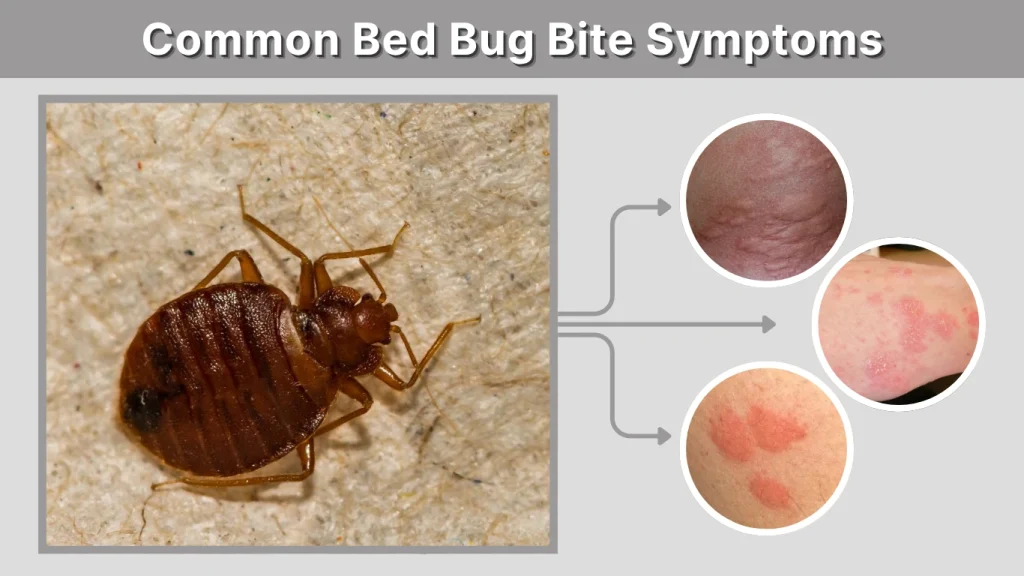 Common Bed Bug Bite Symptoms