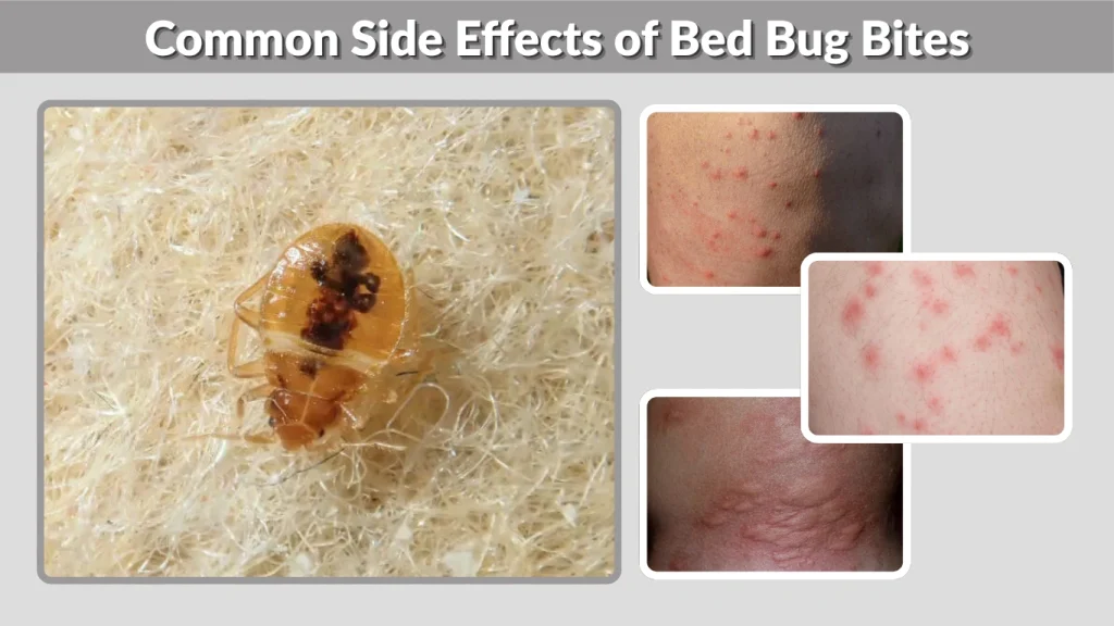 Common Side Effects of Bed Bug Bites