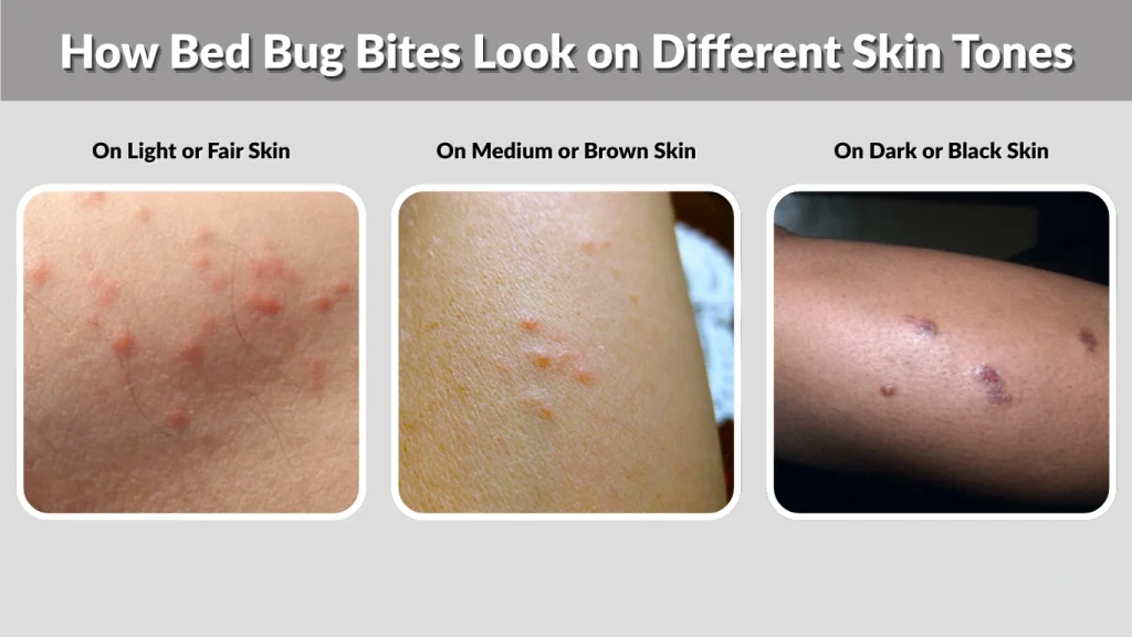 How Bed Bug Bites Look on Different Skin Tones
