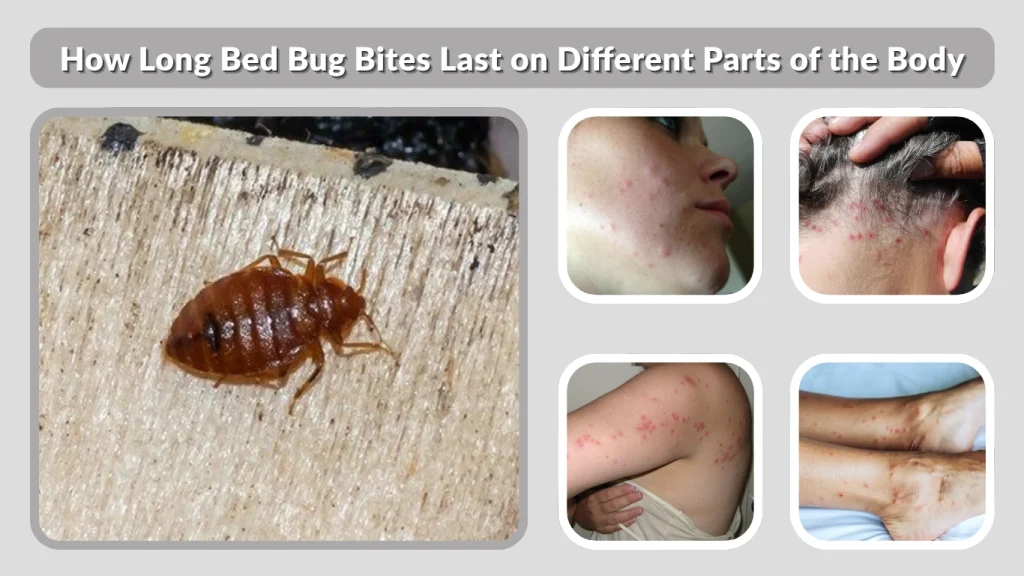 How Long Bed Bug Bites Last on Different Parts of the Body