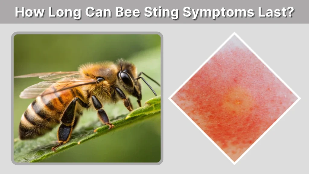 How Long Can Bee Sting Symptoms Last