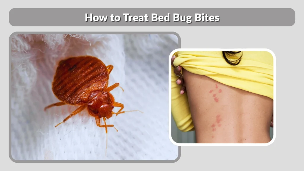 How to Treat Bed Bug Bites