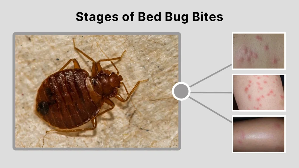 Stages of Bed Bug Bites