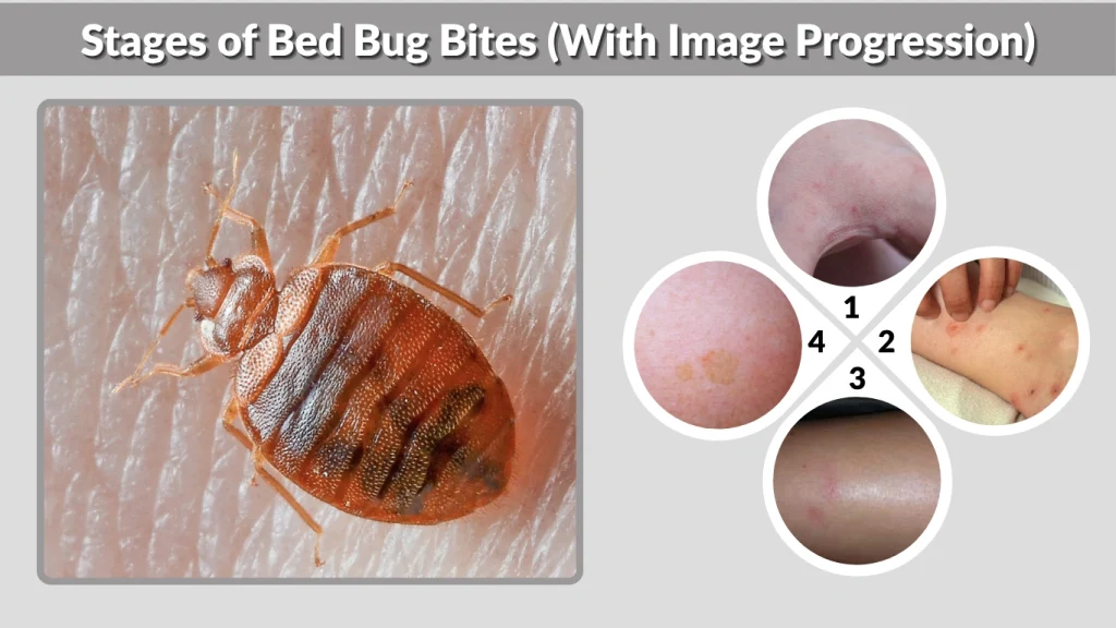 Stages of Bed Bug Bites (With Image Progression)