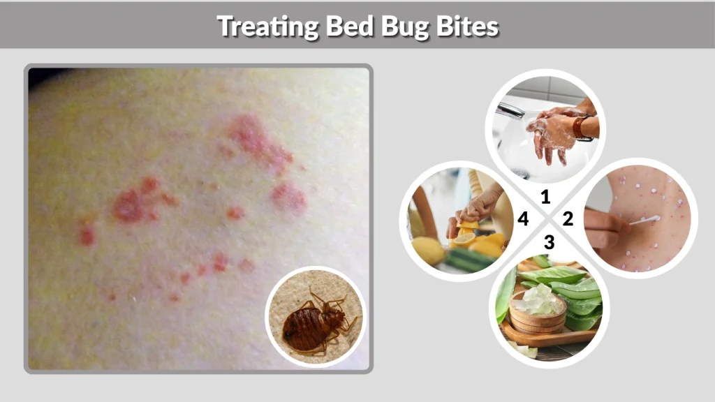 Treating Bed Bug Bites