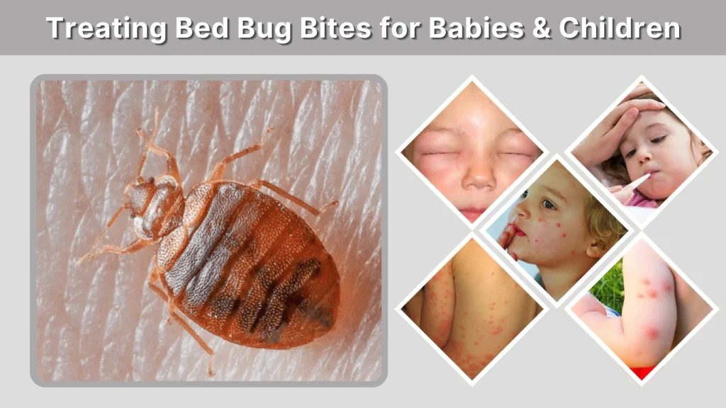 Treating Bed Bug Bites for Babies & Children