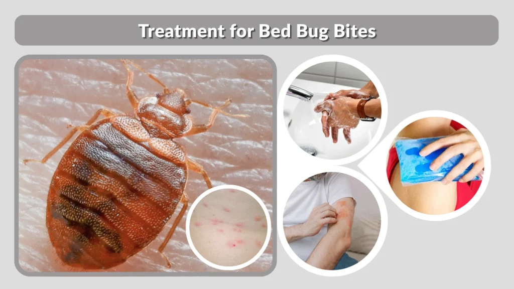 Treatment for Bed Bug Bites