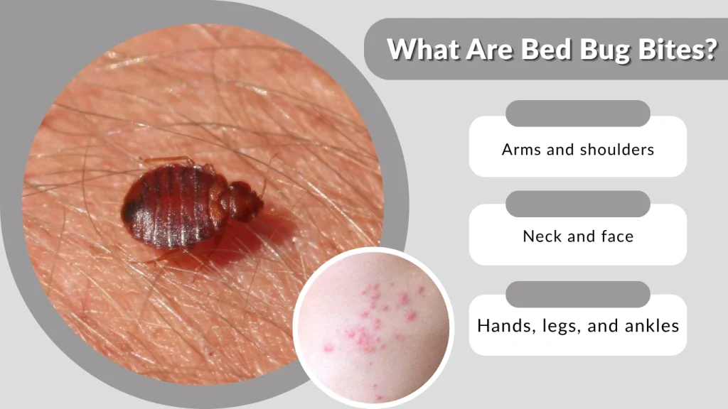 What Are Bed Bug Bites