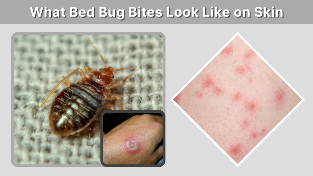 What Bed Bug Bites Look Like on Skin