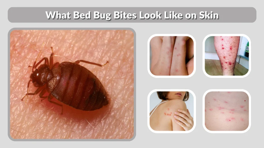 What Bed Bug Bites Look Like on Skin