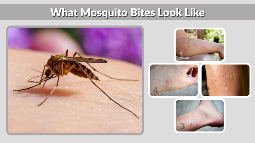 What Mosquito Bites Look Like