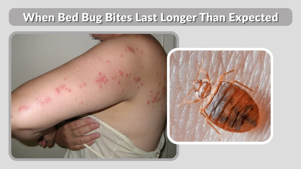 When Bed Bug Bites Last Longer Than Expected