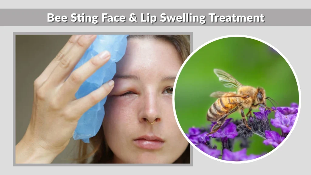 Bee Sting Face & Lip Swelling Treatment
