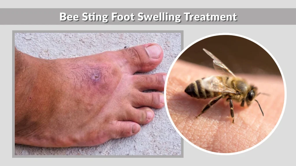 Bee Sting Foot Swelling Treatment
