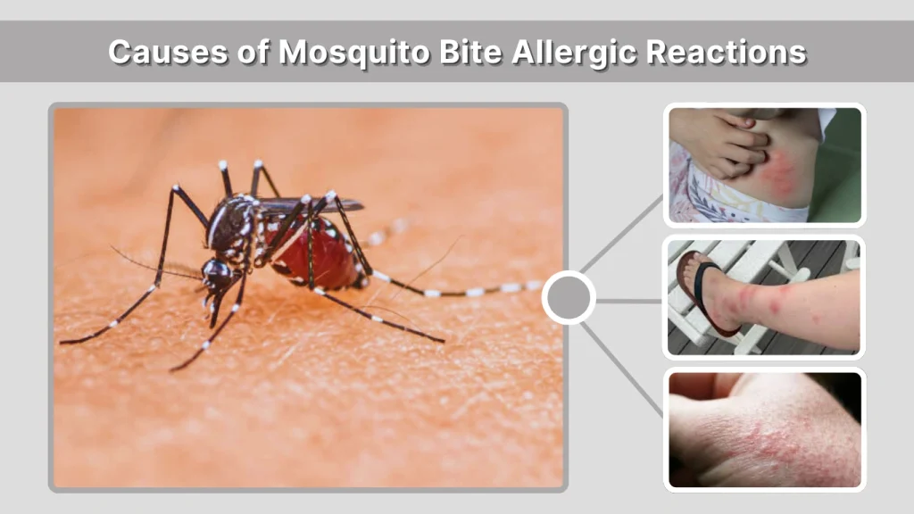 Causes of Mosquito Bite Allergic Reactions