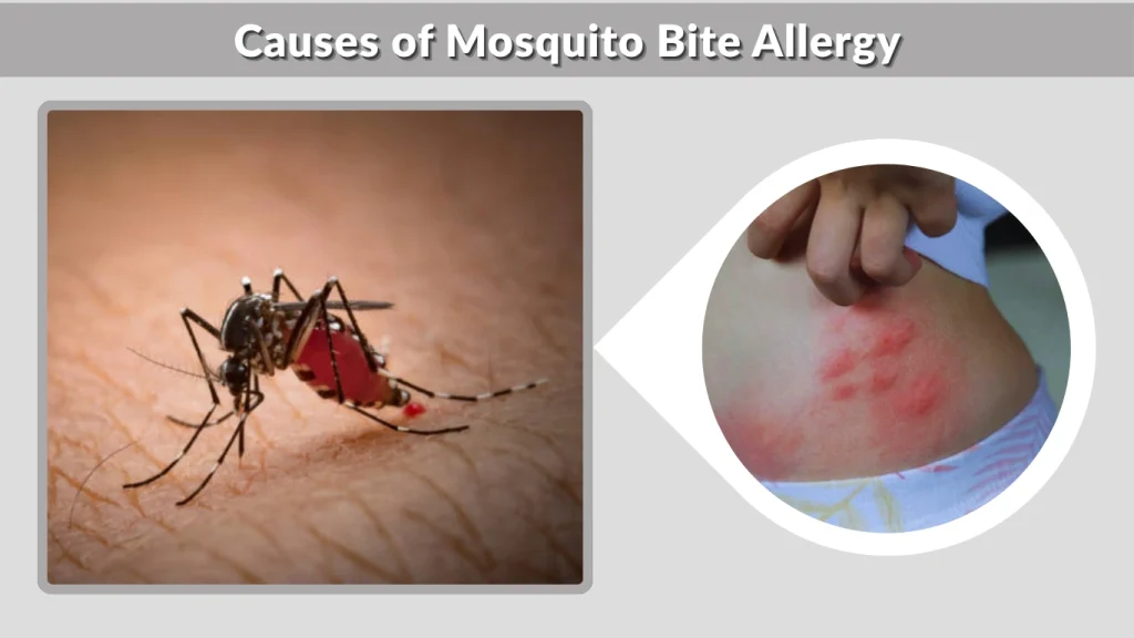 Causes of Mosquito Bite Allergy
