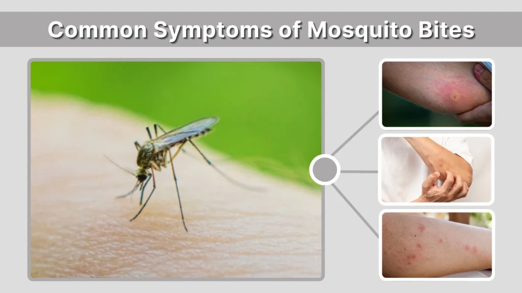Common Symptoms of Mosquito Bites