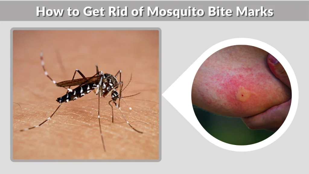 How to Get Rid of Mosquito Bite Marks