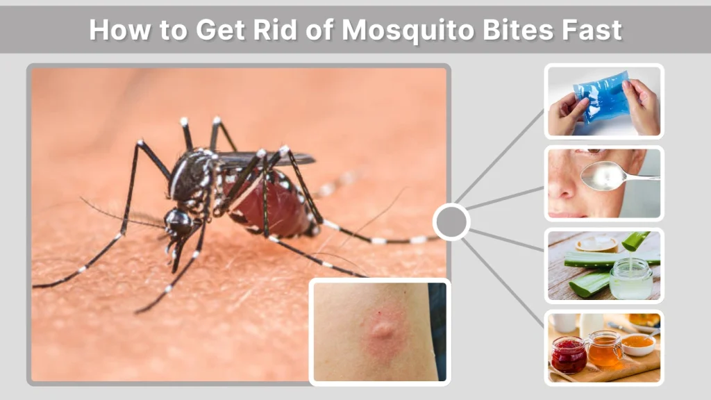 How to Get Rid of Mosquito Bites Fast