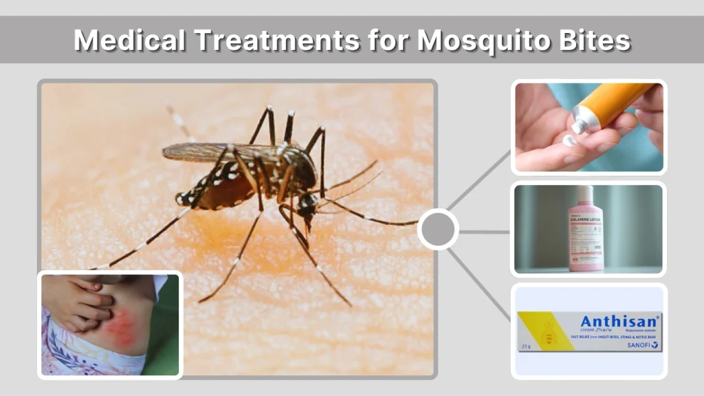 Medical Treatments for Mosquito Bites