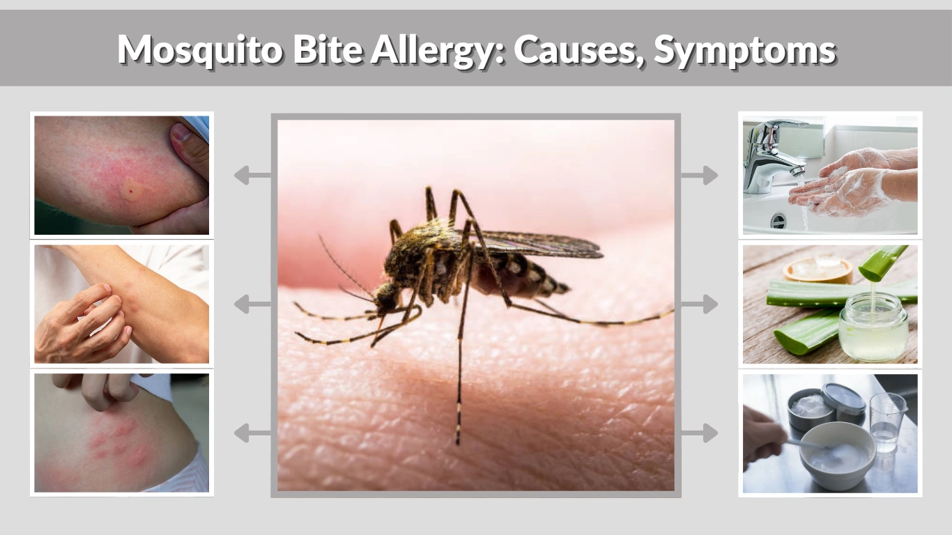 Mosquito Bite Allergy Causes, Symptoms, Treatment & Prevention
