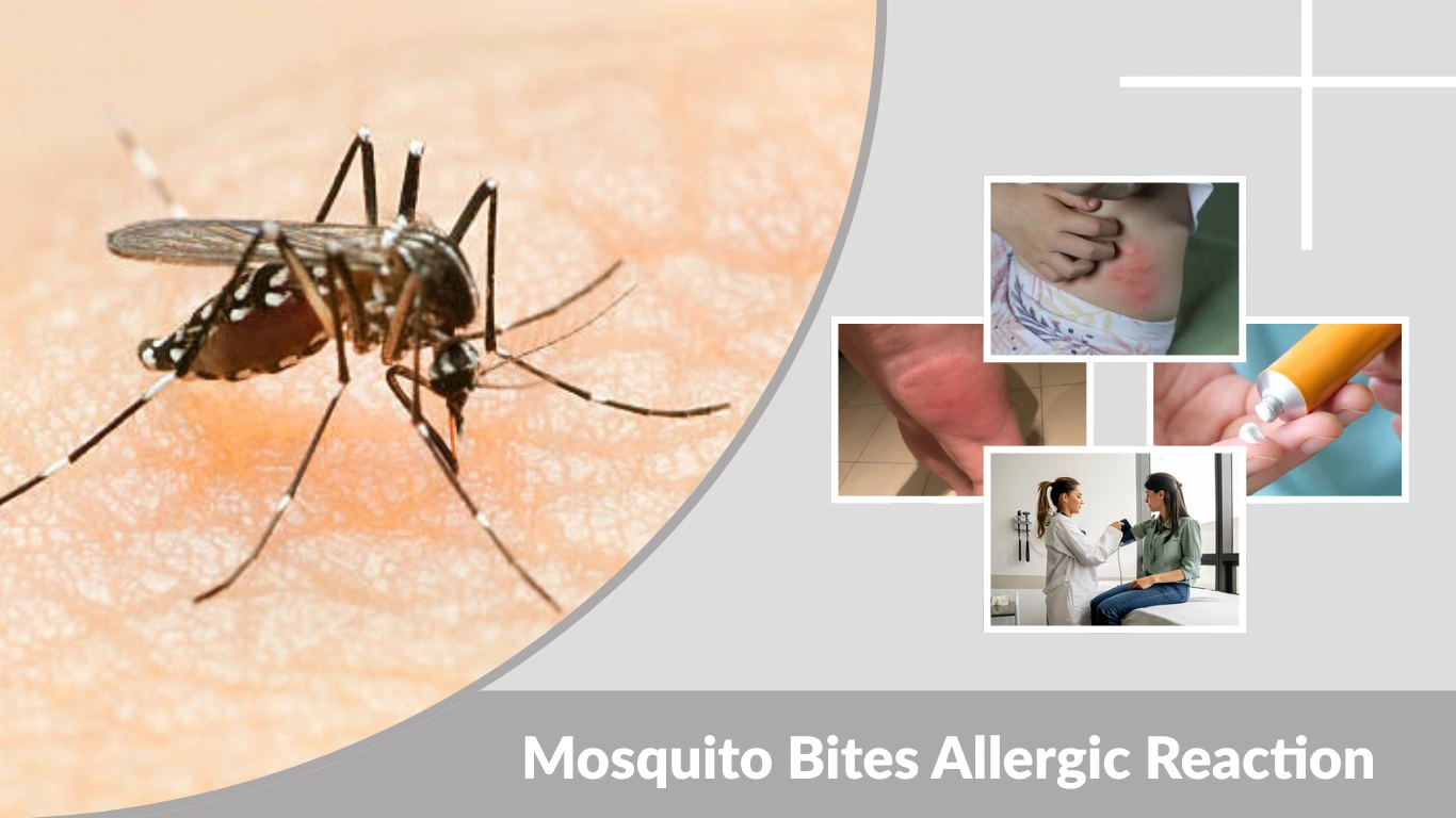 Mosquito Bites Allergic Reaction Symptoms & Effective Treatment