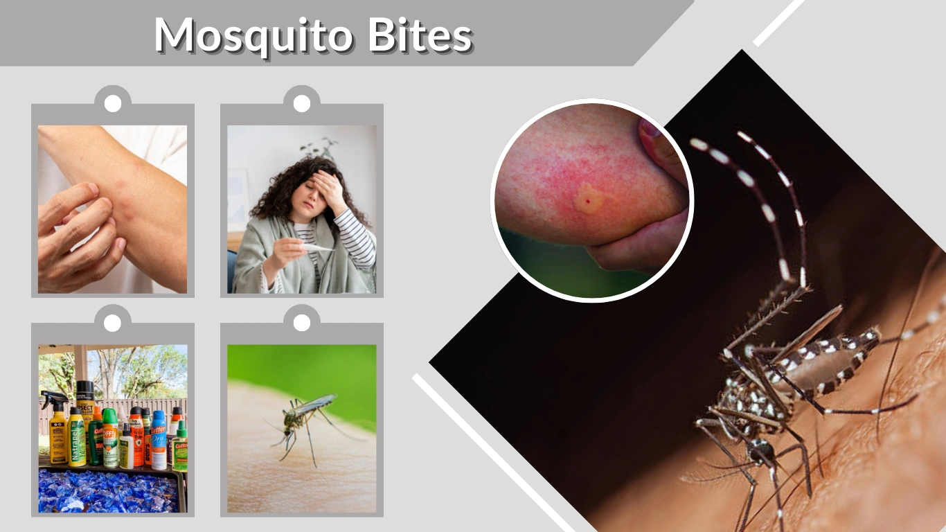 Mosquito Bites Causes, Symptoms, Treatment & Prevention