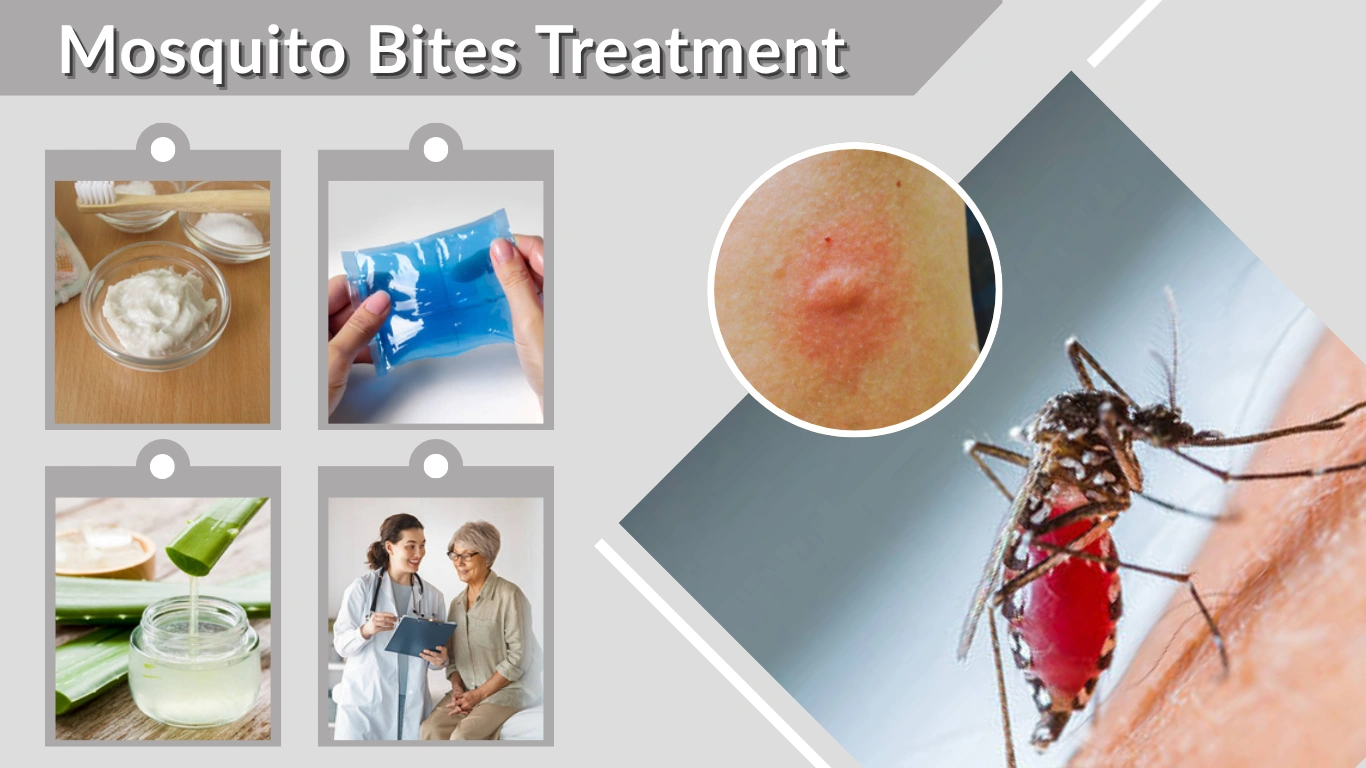 Mosquito Bites Treatment Fast Relief, Remedies & Prevention
