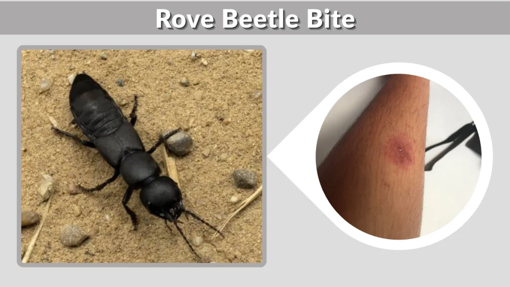 Rove Beetle Bite