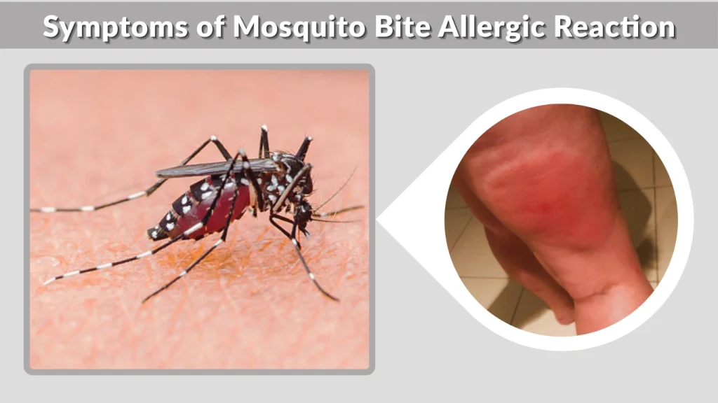 Symptoms of Mosquito Bite Allergic Reaction