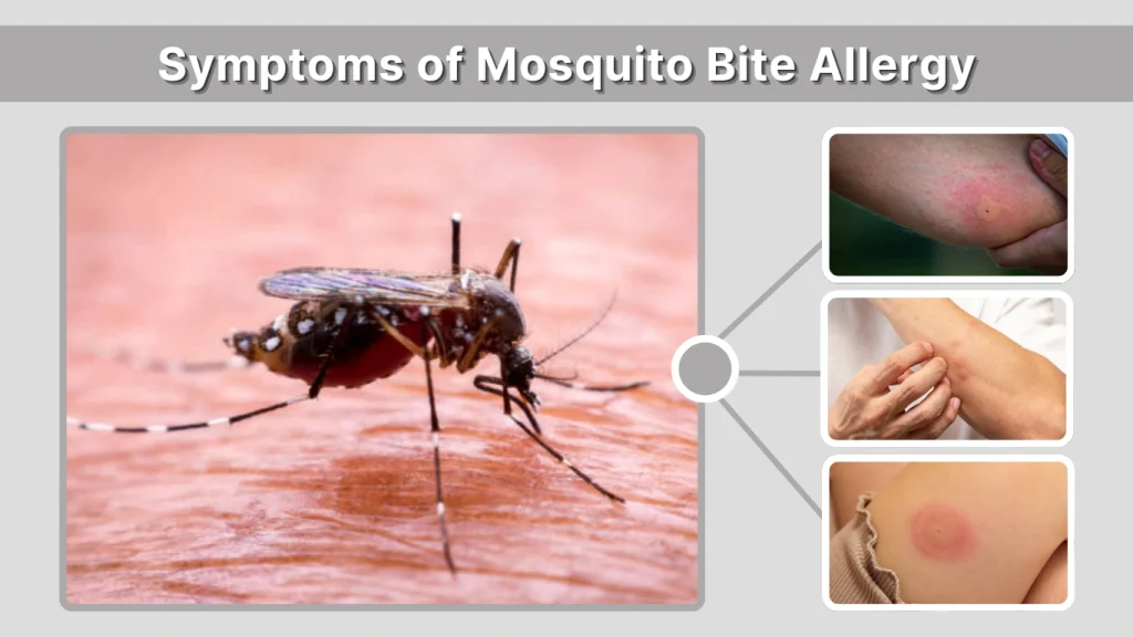 Symptoms of Mosquito Bite Allergy