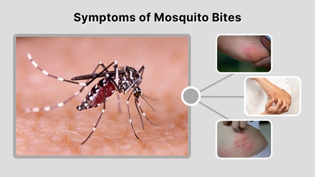 Symptoms of Mosquito Bites