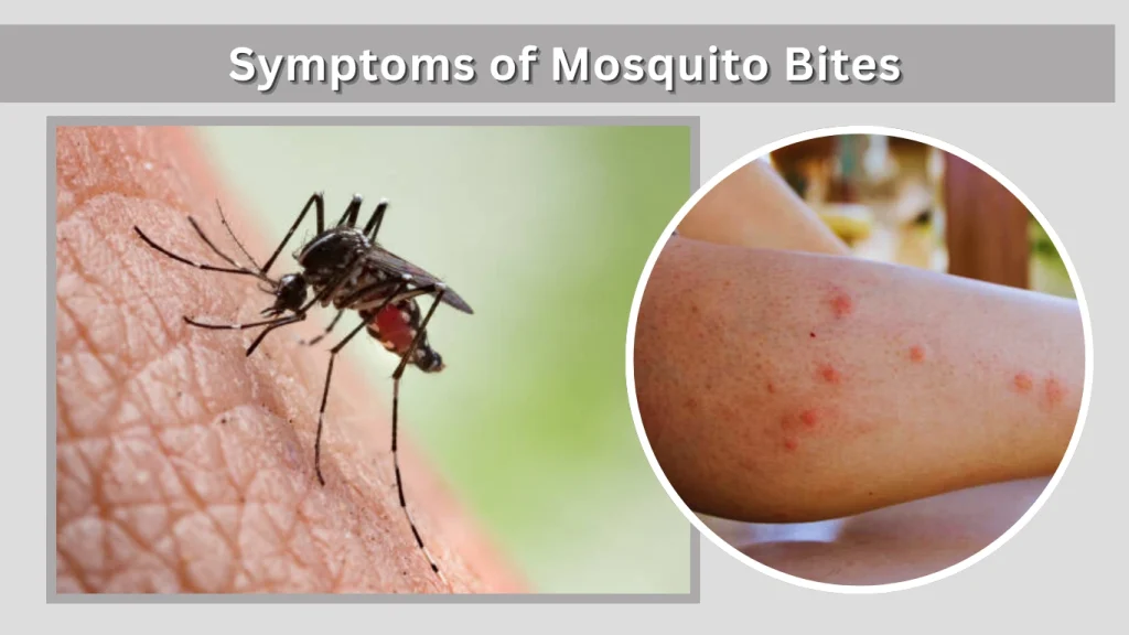 Symptoms of Mosquito Bites