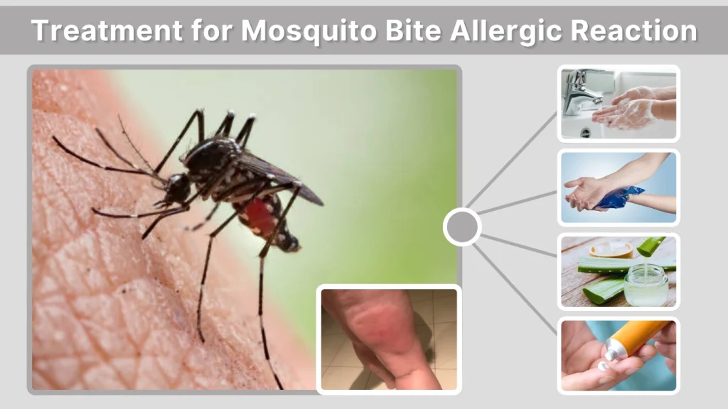 Treatment for Mosquito Bite Allergic Reaction