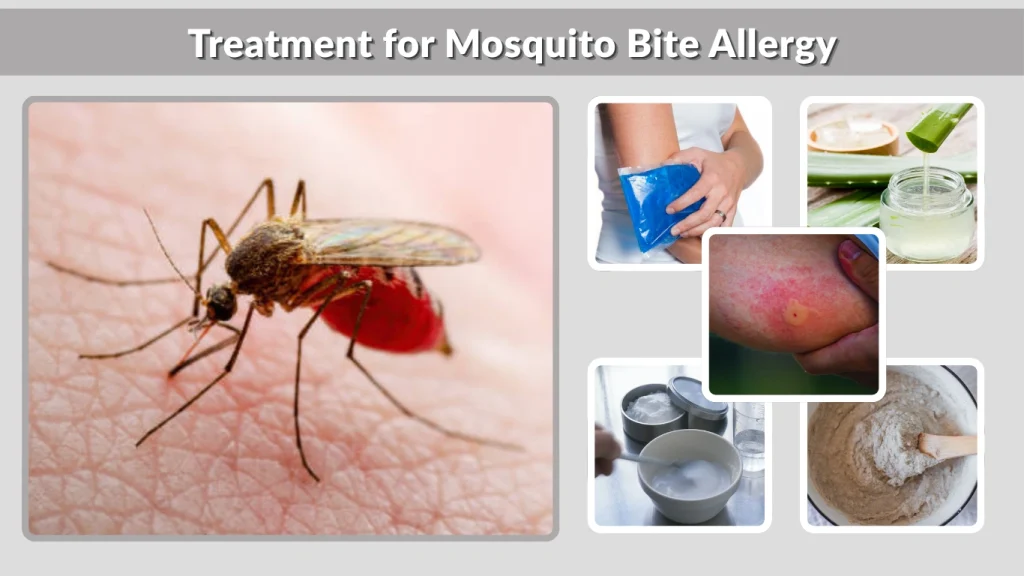 Treatment for Mosquito Bite Allergy
