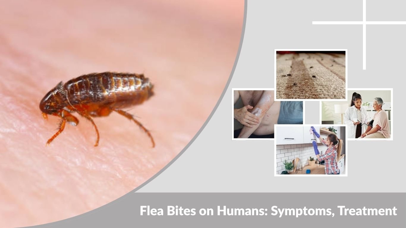 Flea Bites on Humans: Symptoms, Treatment & Prevention Guide