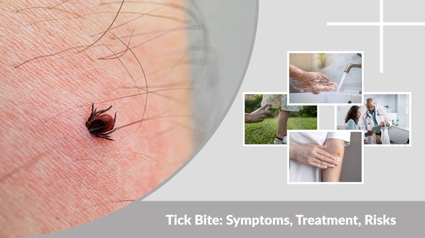 Tick Bite: Symptoms, Treatment, Risks & Prevention Guide